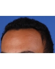 After Hair Transplant&nbsp;Front